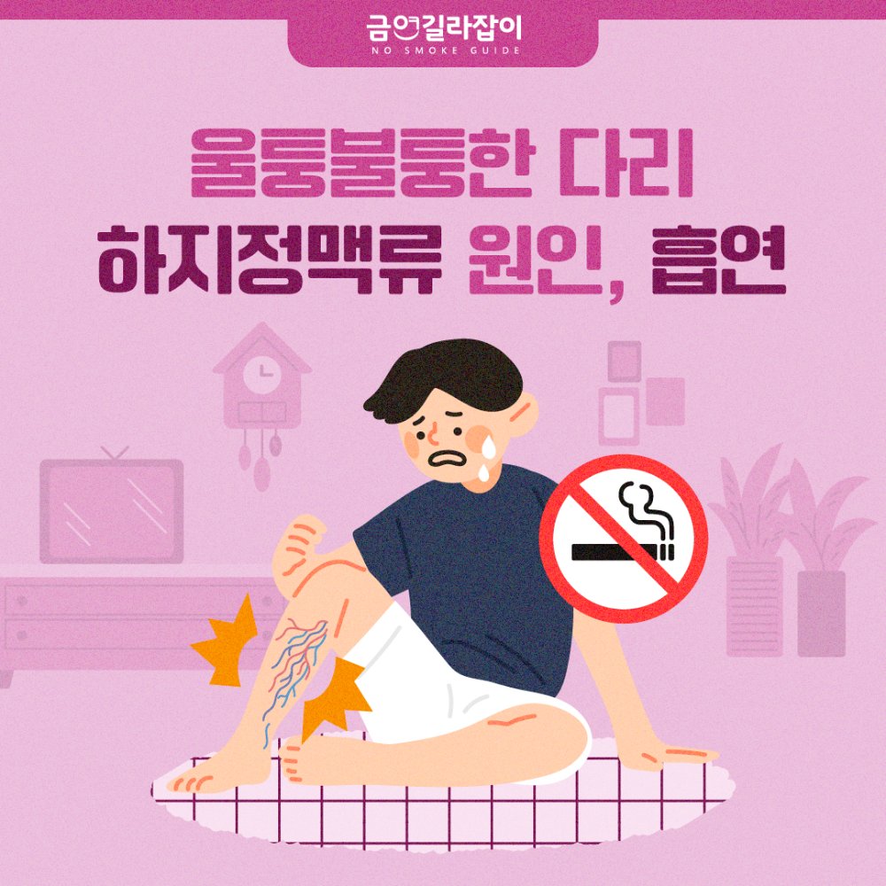 하지정맥류원인(1)